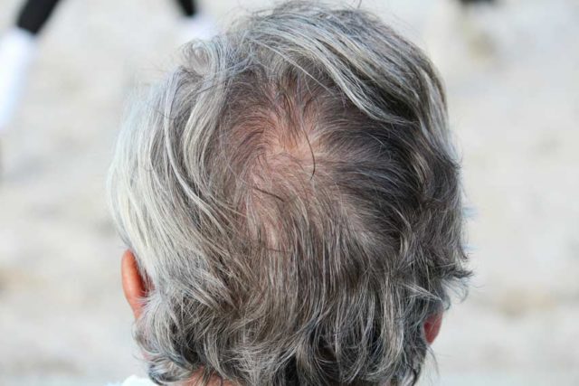 Как лечить выпадение волос у мужчин - народные средства и препараты