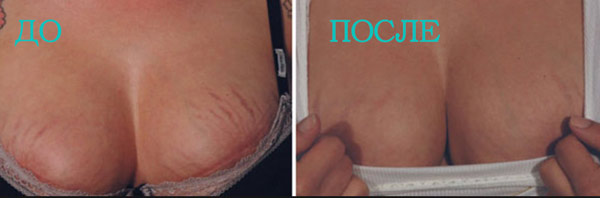 Мезотерапия от растяжек на груди (фото до и после)