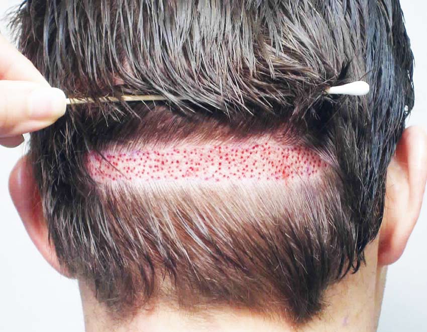Методы по пересадке волос