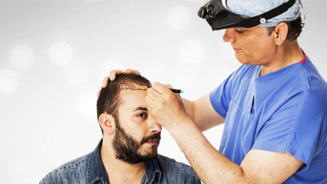 В каких случаях поможет пересадка волос на голове?