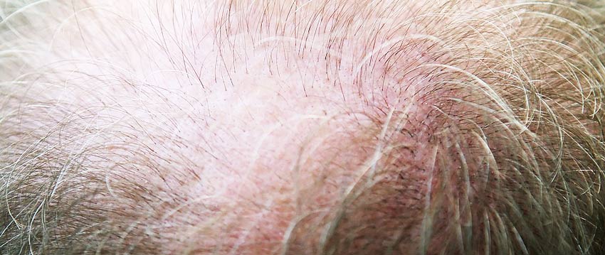 Виды диффузного выпадения волос